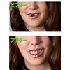 Instant Smile Teeth DX-S, 0.04 oz (1 g) (x1)
