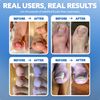 CurveCorrect Ingrown Toenail Home Treatment