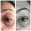 Cream Eyelid Eczema Eye eczema non steroid