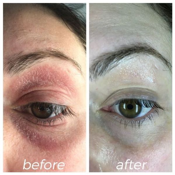 Cream Eyelid Eczema Eye eczema non steroid