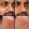 KODE Mens Concealer (Lightest) – Dark Circle Under Eye Cream Corrector, Multi-Use, Pimples, Scars, Rashes