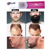 Beard Derma Roller Titanium 540 beard Growth Roller Micro Needle Acne Scars