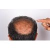 dht blocker with immune support - DHT BLOCKER HAIR COMPLEX - zinc for men 2B