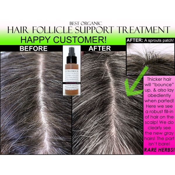 ORGANIC HAIR REGROWTH TREATMENT MEN & WOMEN HAIR LOSS TREATMENT NATURAL & FAST