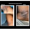 4oz. Hidradenitis Suppurativa cream