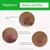 Mepiform with Safetac Technology 4"x7", 5 Count, Self Adherent Soft Silicone Sheeting for Scar Reduction