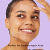 Avarelle Pimple Patches (16 Count) Hydrocolloid Acne Cover Patches | Zit Patches for Blemishes, Zits and Breakouts with Tea Tree, Calendula and Cica Oil for Face | Vegan, Cruelty Free Certified, Carbonfree Certified (Hydrocolloid, Square 1/2 - 16 Count)