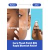 Olive Young Care Plus Spot Patch Big (81 Count) | Hydrocolloid Patch, Spot Stickers for Acne Pimple Blemishes and Zits