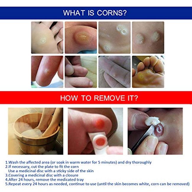 How to Remove Corns and Calluses Naturally, StethNews
