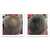 Caboki Hair Concealer. (16G, 40-Day Supply) Dark Gray