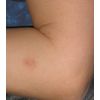 Helps make your Pet Ulcers go away from Spider Bites and Tick bites
