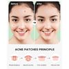 ZATKTK Acne Pimple Patch (180 Counts 4 Sizes), Invisible Hydrocolloid Acne Patch with Tea Tree Oil & Calendula Oil, Acne Spot Healing Patch Zit Patches for Face
