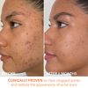 Dr Dennis Gross Alpha Beta Extra Strength Daily Peel: for Oily Skin, Uneven Tone or Texture, Wrinkles or Enlarged Pores (5 Treatments)