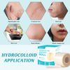 Hydrocolloid Patches 5cm x 5m