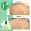 Oxe'Cure Oxe Cure Acne Solution Body Starter Kit : Acne Spray 50 ml + Soap 30g