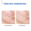 aknederm Daily Cosmetic Set for Normal Skin, 230 ml