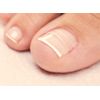 CurveCorrect Ingrown Toenail Home Treatment