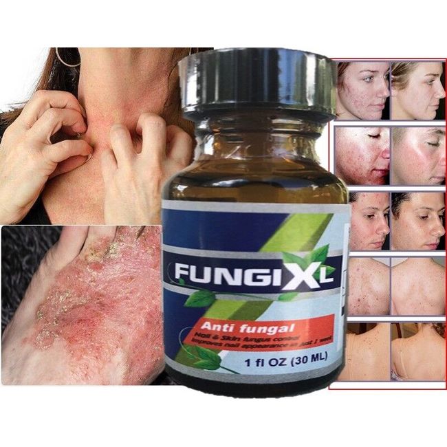 Pimple Scar & Acne Mark Spots Removal Gel Ointment Blemish Cream Antifungal wart