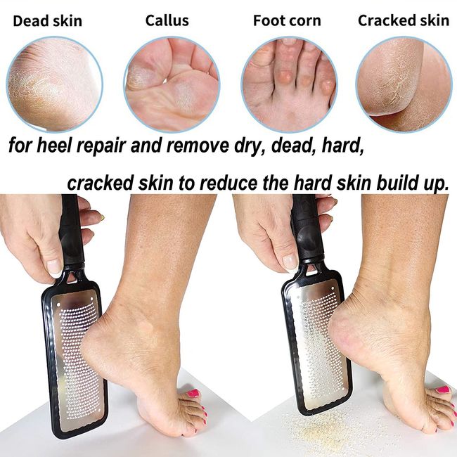 Colossal Foot Rasp Foot File and Callus Remover,Surgical Grade Stainless  Steel File to Remove Hard Skin, Foot Corn, Cracked Heels,Can be Used on  Both Wet and Dry Feet 