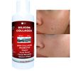 Skin Scars Silicon and Collagen Hydrolyzed Gel Resurfacing Skin Collagen Promoter For Indented Atrophic Rolling Face Scars By ALKA VITA
