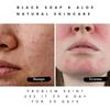 Top Acne Soap Brands for Clear Skin