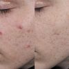 BYOMA Blemish Clearing Paste