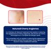 Naturasil Cherry Angiomas 10ml | Liquid Roller