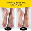 PedEgg Original Ergonomic Foot File and Callus Remover by BulbHead