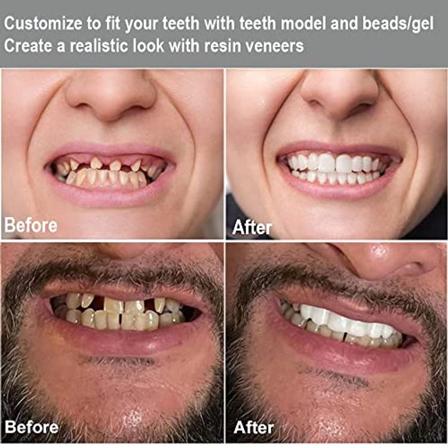 Tooth Repair Beads Replacement for Filling Gaps Thermal Fitting