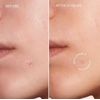 Marine Skincare Acné Patches 72dots (2pack =144)