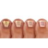 Pronail Plus Fungal Nail Solution 10 ml Brush Application