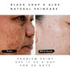 Top Acne Soap Brands for Clear Skin