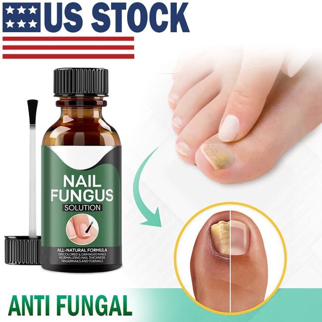 ANTI FUNGAL TREATMENT EXTRA STRENGTH TOENAIL FUNGUS ATHLETES FOOT FUNGI NAIL #1