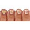 Pronail Plus Fungal Nail Solution 10 ml Brush Application Twin Pack
