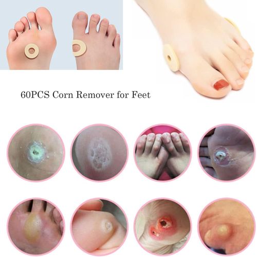 60PCS Corn Remover for Feet, Corn Protectors for Toes,Toe Pads Corn Pads Self Adhesive, Remove Corns on feet Overnight, Soft Waterproof for Foot Protectors Reduce Foot and Heel or Toe Pain