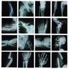 16 Pcs Broken Bones X-Ray Set, Black and White Skeleton Pretend X-Rays, 9.84" x 9.84"