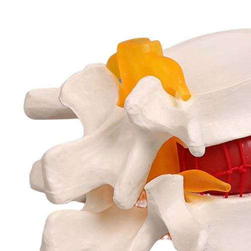 Human Anatomical Lumbar Disc Herniation Model 1.5 Times Life Size Portable Model Tool Anatomy Medicine Teaching for Medical Learning and Scientific Presentations