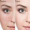Blackhead, Whitehead Remover Kit, Comedone Extractor Tool Skin Treatment 4 Piece
