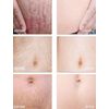 stretch marks Moisturize, Smooth, Firm, Repair
