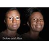 Keromask Full Coverage Hypoallergenic Concealer White Mixer to Camouflage Vitiligo, Tattoos, Redness and Rosacea, Waterproof and Suitable for All Skin Types 1 x 15ml
