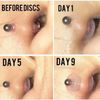 Bloomfall 3MM 50PCS 5MM 50PCS Clear Piercing Disc For Piercing Bump,Pressure Silicone Earrings For Keloids Healing Pads Belly Button Piercing Kit