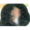 dht blocker with immune support - DHT BLOCKER HAIR FORMULA - zinc tablets 2BOTTL