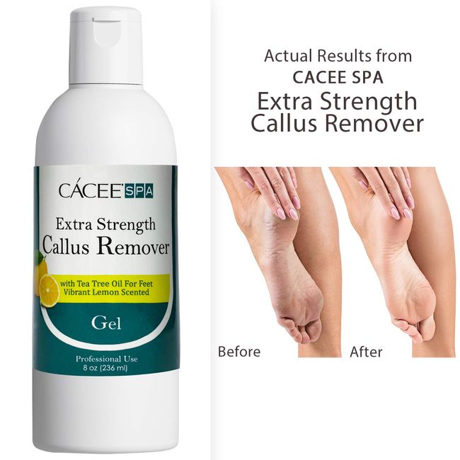 Cacee Callus Remover for Feet 8oz Gel Formula with Tea Tree Oil & Lemo