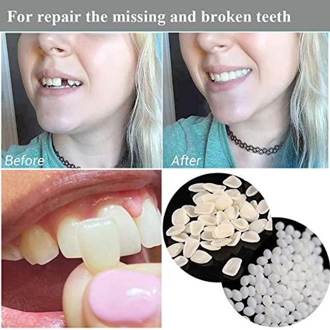 Moldable False Teeth, Tooth Repair Granules, Tooth Beads, Temporary Filling  for Rooth, Broken Tooth Repair Kit, Thermal Fitting Beads for Snap on  Instant and Confident Smile White