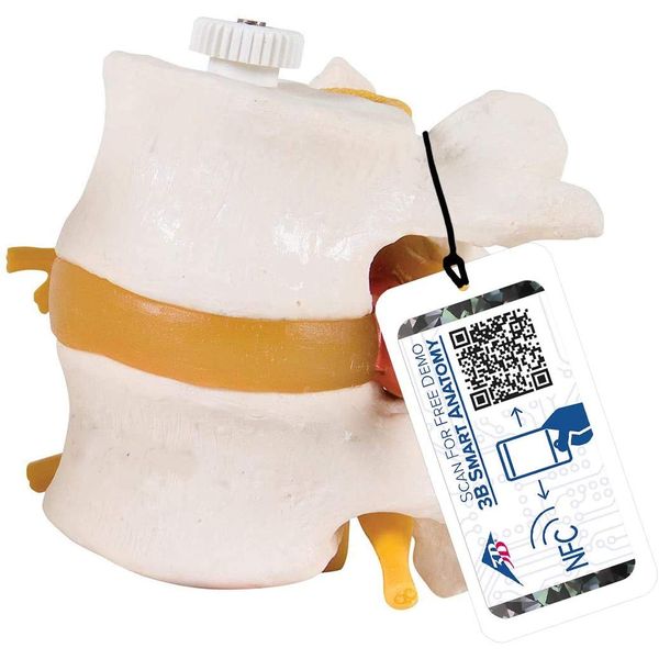 Lumbar (L4,L5) model with herniated cord, connects with intervertebral discs and spinal nerves can be observed - 2 interlocking lumbar models - 3B Scientific