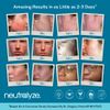 Neutralyze Moderate To Severe Acne Treatment Kit 2.0 - Maximum Strength Acne Kit, 2% Salicylic Acid, Mandelic Acid & Nitrogen Boost Skincare Technology - Acne Treatment for Teens & Adults (90+ Day)