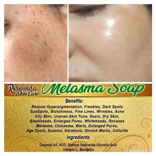 Melasma Soap Lighten Dark Spot Remove Hyperpigmentation Acne Pimples Freckles