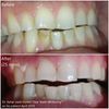 Blanqueador De Dientes Laser Gel KIT Tiktok