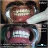 Blanqueador De Dientes Laser Gel KIT Tiktok