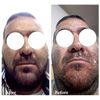 Demodexcillin Skin Solution 4 Fl.Oz Recommended For Acne, Rosacea, Blepharitis